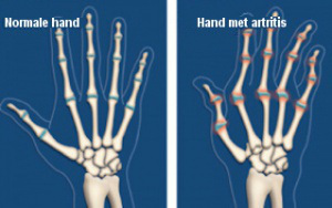 hand-met-artritis