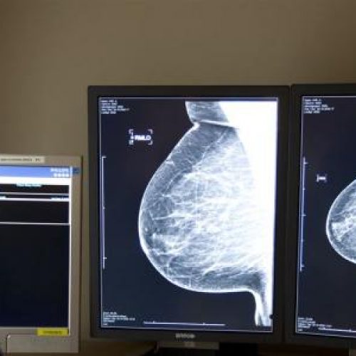 Borstkankertumoren binnen 11 dagen verdwenen na revolutionaire behandeling