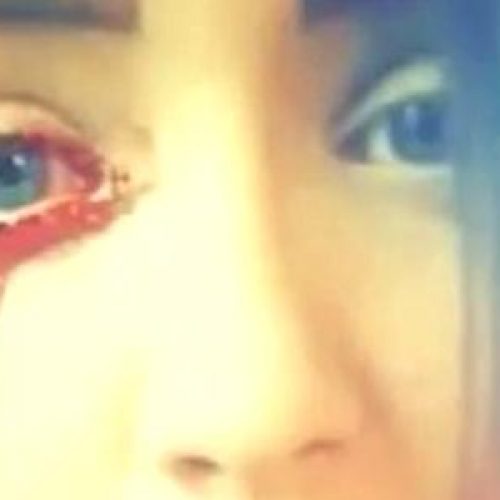 Haar ogen bloeden en artsen weten niet waarom