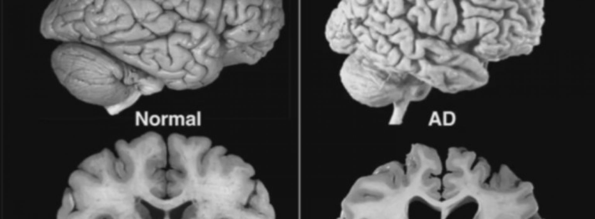 Dit is wat cocaïne doet met je hersenen en met je lichaam