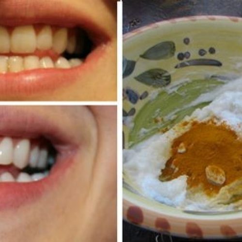 Deze Kurkuma Anti-Ontsteking Pasta zal tandvleesaandoeningen en zwelling terugdraaien en bacteriën doden