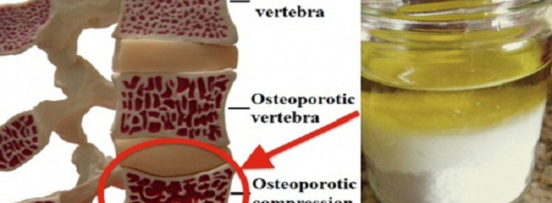 Het meest krachtige en genezende mengsel tegen osteoporose!