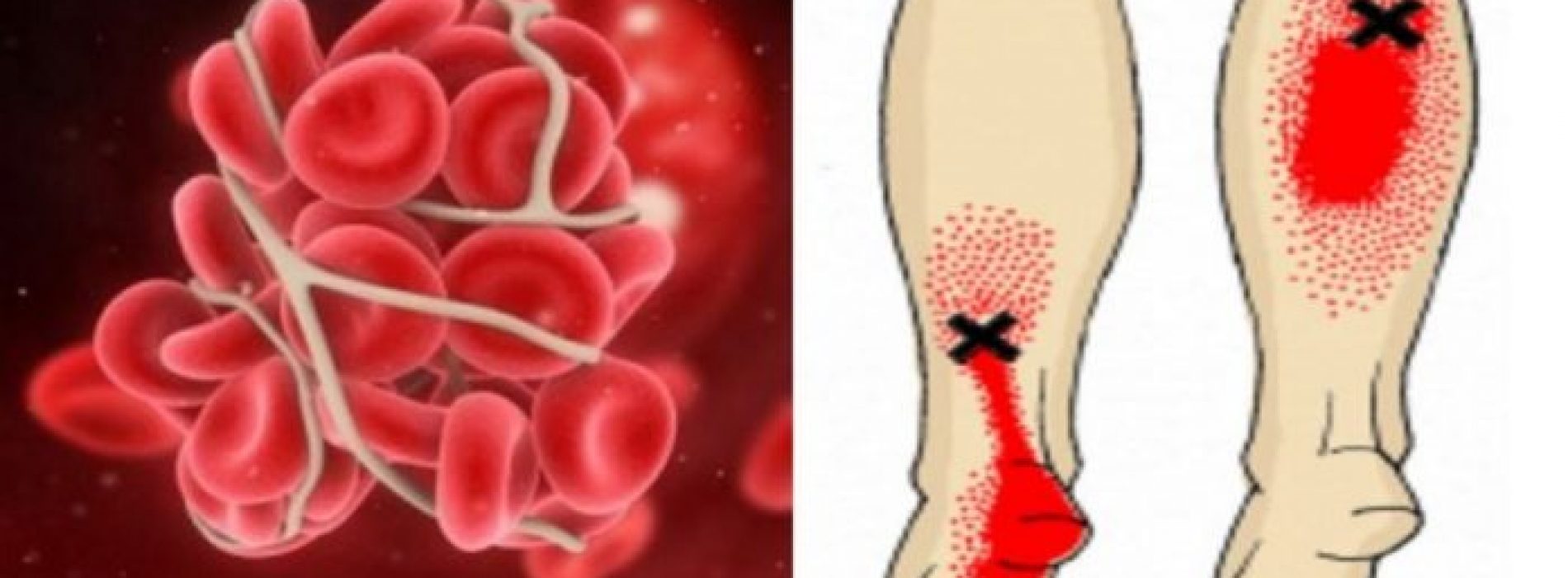 8 makkelijk-te-missen tekenen die je misschien wel waarschuwen voor een bloedprop/trombose