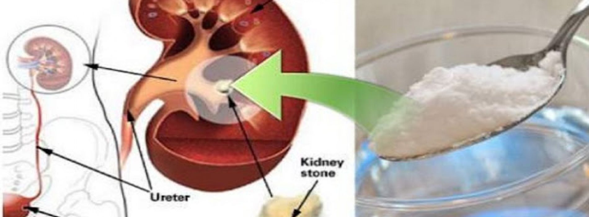 Hoe je de nieren natuurlijk kunt repareren door gebruik van Baking Soda (en waarom je dat zou moeten doen)…