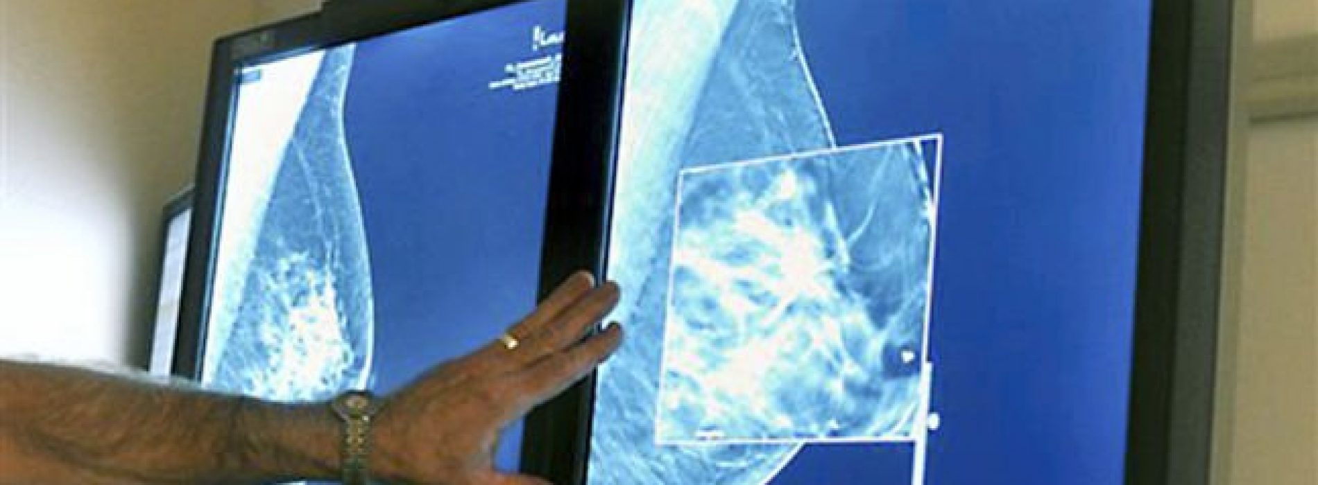 Arts: “Mammogrammen veroorzaken borstkanker”