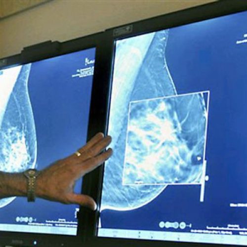 Arts: “Mammogrammen veroorzaken borstkanker”