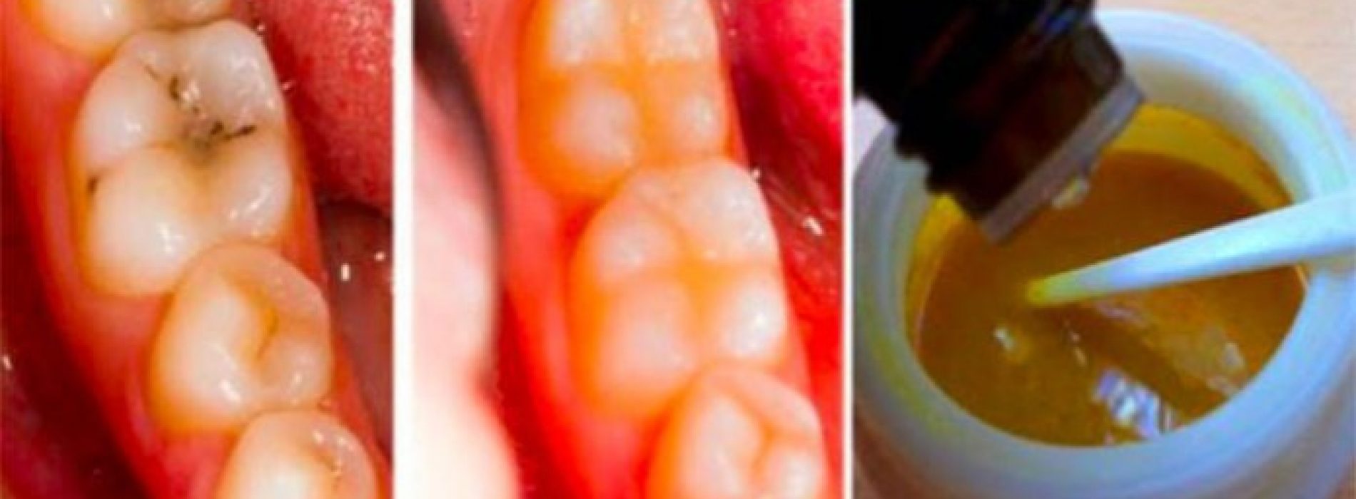 Genees gaatjes natuurlijk en genees tandbederf met deze krachtige tanden maskers