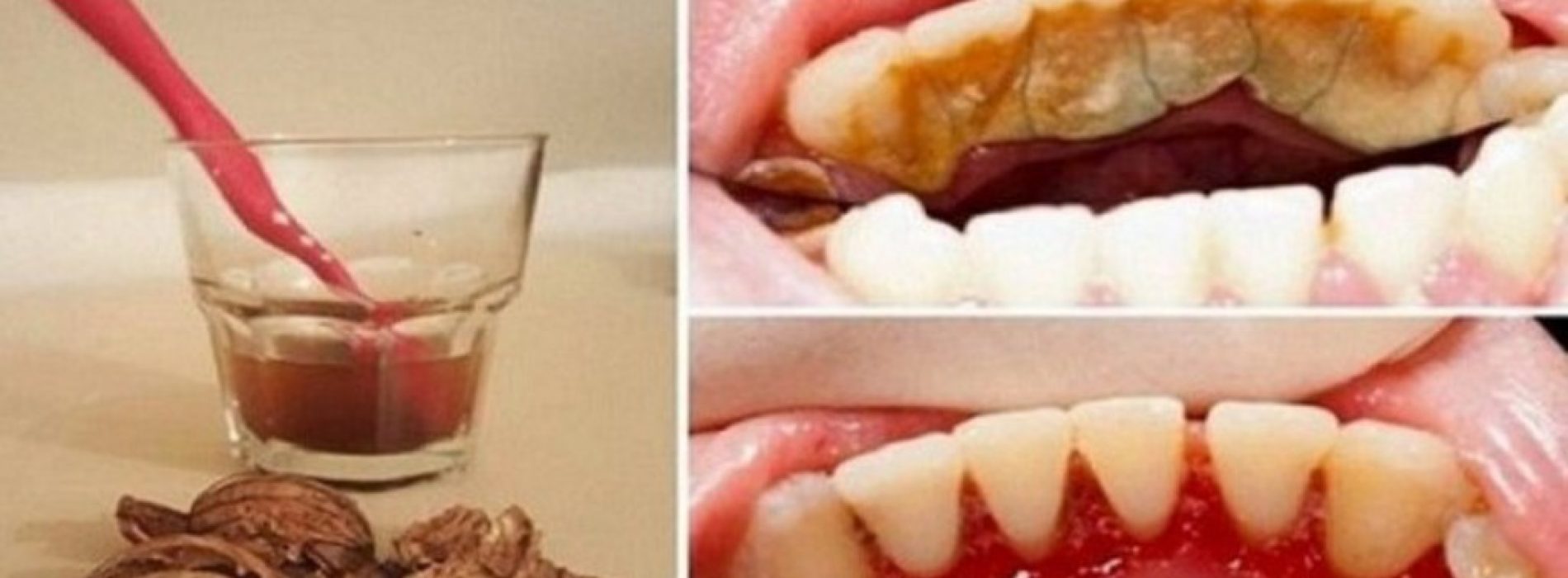Tandplak, tandsteen en bloedend tandvlees behoren tot het verleden dankzij walnoten, GEWELDIG!