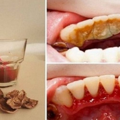 Tandplak, tandsteen en bloedend tandvlees behoren tot het verleden dankzij walnoten, GEWELDIG!