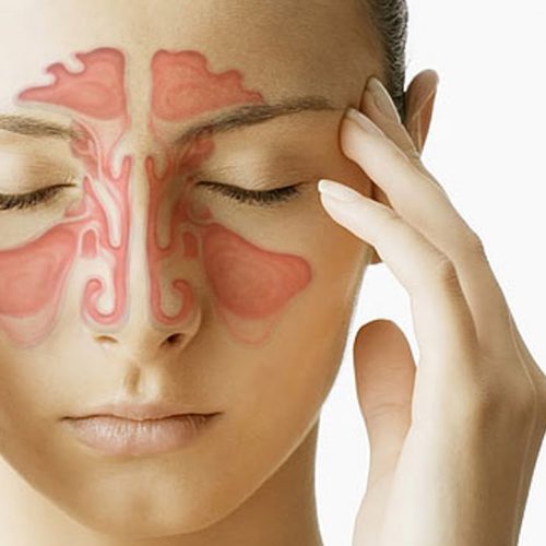 Hoe u weet dat u een sinusinfectie heeft en geen verkoudheid