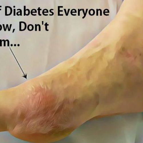 10 tekenen van diabetes die iedereen zou moeten weten, negeer ze niet …