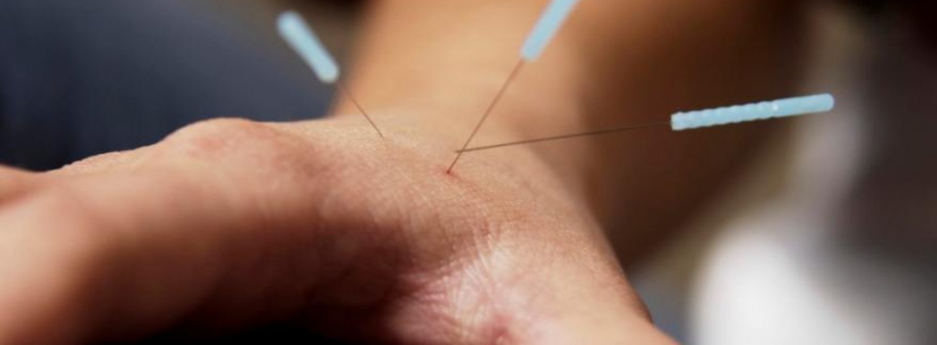Onderzoekers onderzoeken de voordelen van acupunctuur bij reumatoïde artritis van de hand