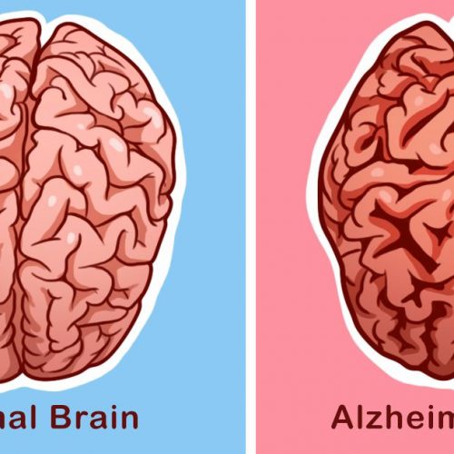 De meeste mensen weten niet het verschil tussen dementie en de ziekte van Alzheimer. Hier leest u hoe u uw risico op beide kunt verminderen