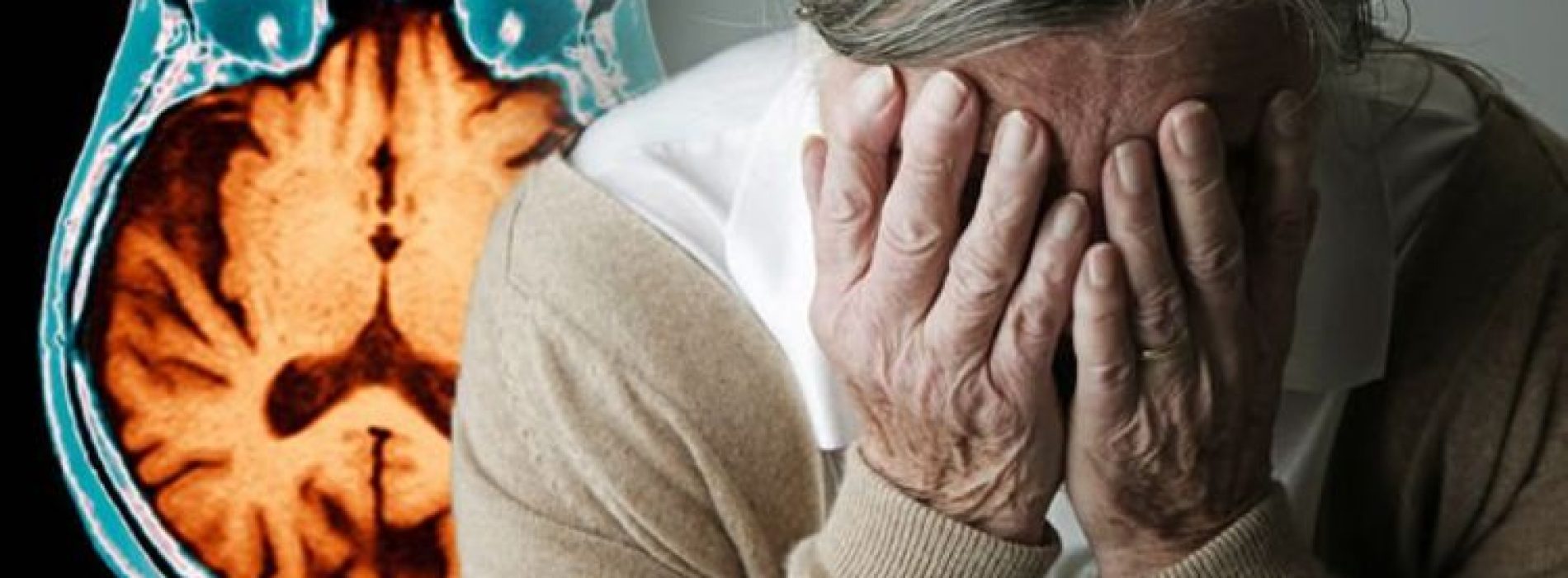 Als u niet genoeg slaap krijgt, versnelt u hersenschade in verband met de ziekte van Alzheimer, waarschuwen onderzoekers