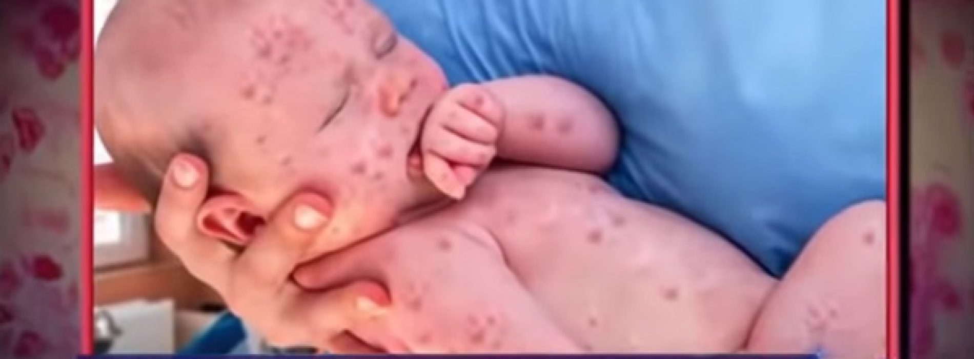Foto’s van baby besmet met mazelen, gefotoshopt door NBC News om massahysterie op te dringen en naleving van vaccins te eisen
