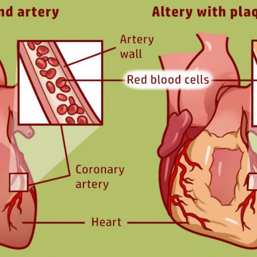 Is je hart gezond? 10 tekenen van slechte gezondheid van het hart en een hartaanval