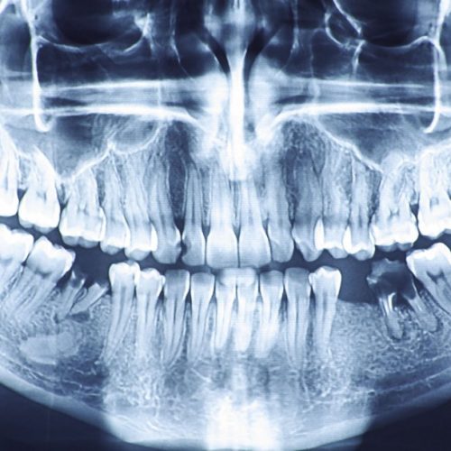 Hartaanval risico verbonden aan ongezonde tanden en tandvlees