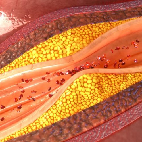 Hoe arteriële plaque te verminderen, op te lossen en om te keren