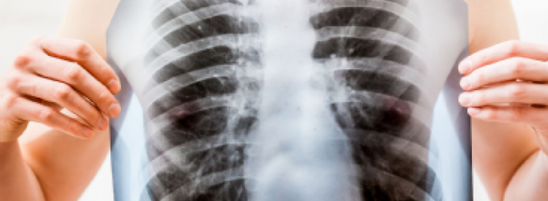 Anti-tuberculose-medicijnen VERHOGEN het risico op herinfectie
