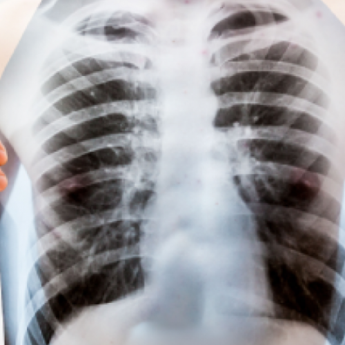 Anti-tuberculose-medicijnen VERHOGEN het risico op herinfectie