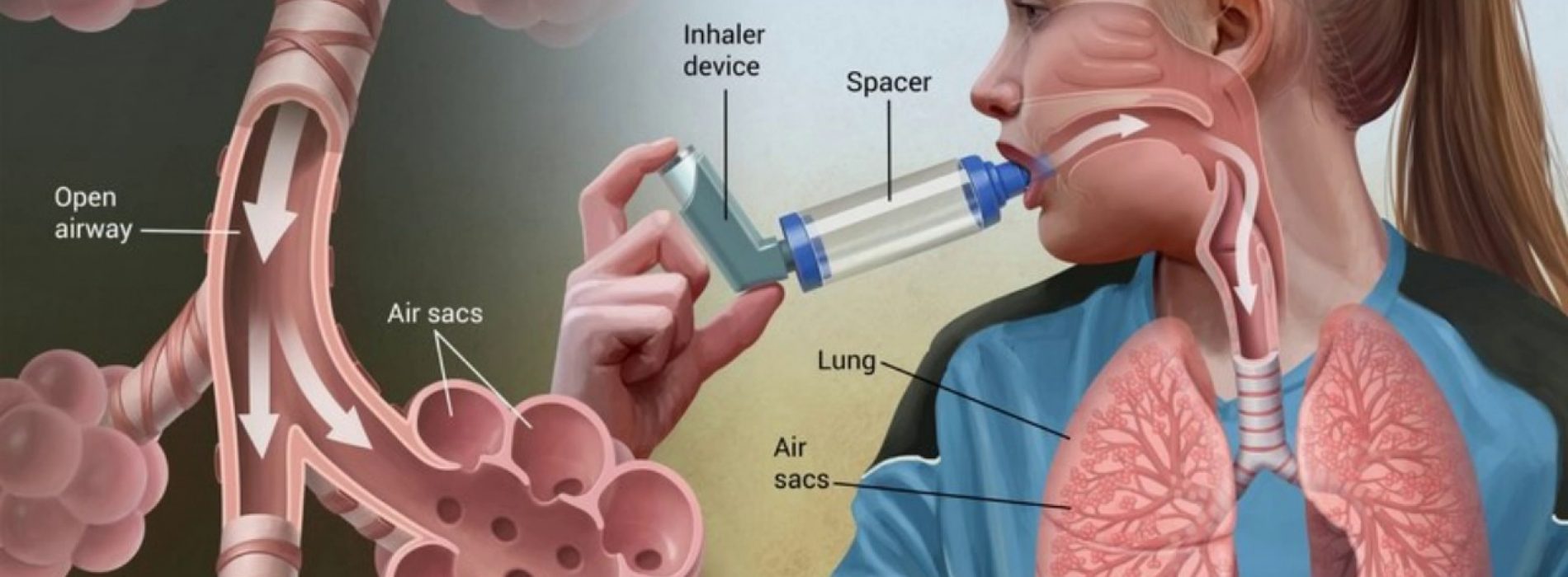 Het ontkrachten van gemeenschappelijke mythen over astma