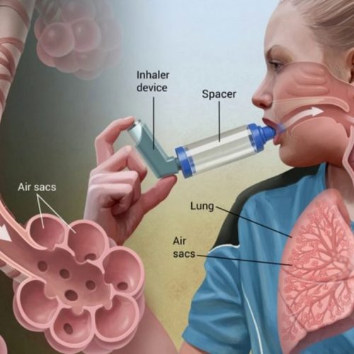 Het ontkrachten van gemeenschappelijke mythen over astma