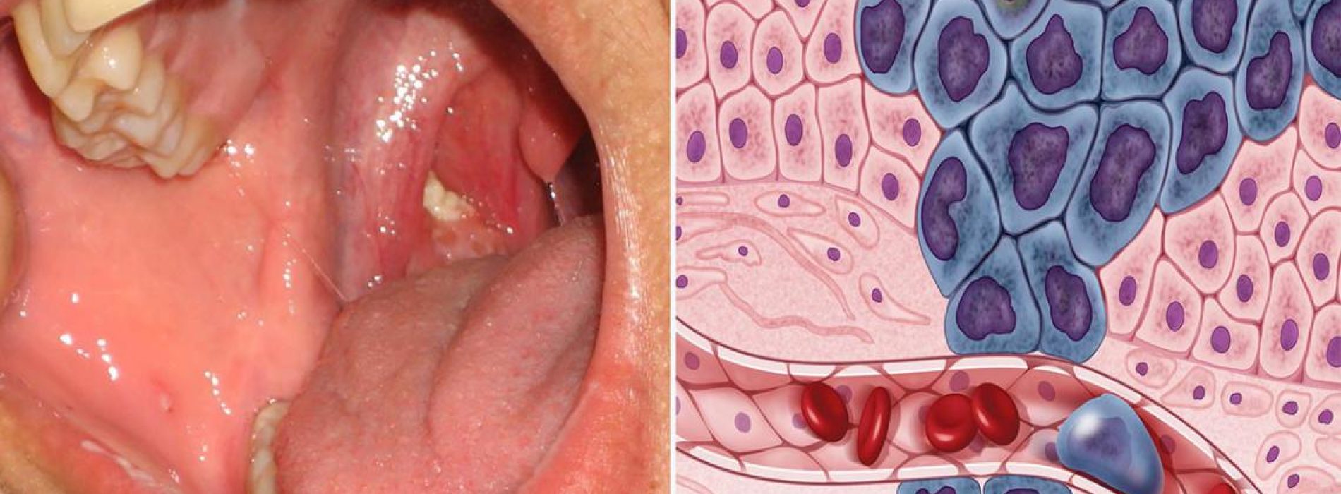 Type bacteriën in mond gekoppeld aan kanker