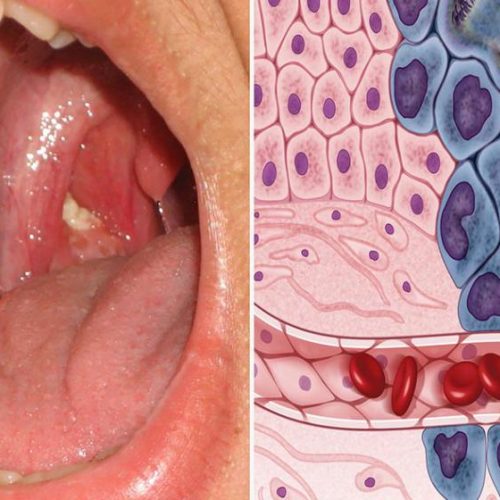 Type bacteriën in mond gekoppeld aan kanker