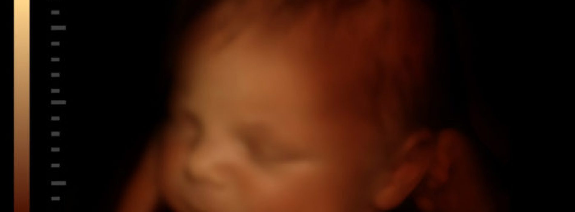 Bevestigd: Abortus lichaamsdelen groep geeft toe dat ze kloppende harten en volledig intacte babyhoofden “geoogst” hebben van abortussen van Planned Parenthood