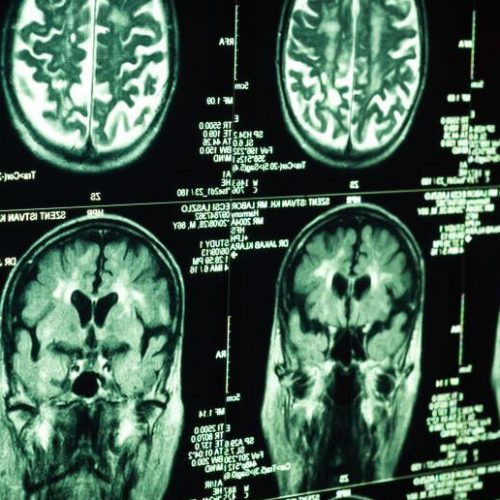 Onderzoekers brengen het brein van Alzheimer in kaart en ontdekken dat één gebied zichzelf lijkt te beschermen tegen achteruitgang