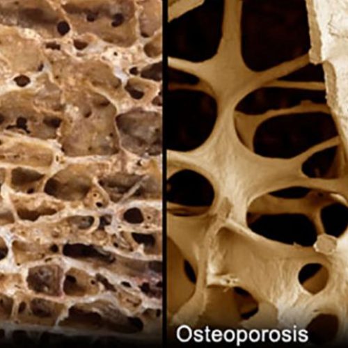 Osteoporose is scheurbuik van het bot, geen calciumtekort