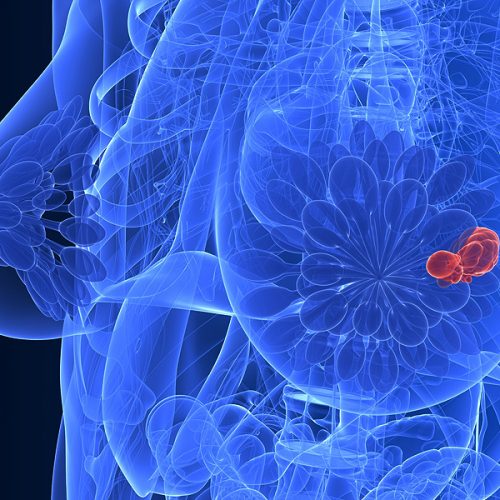 Studies suggereren dat vastendiëten de behandeling van borstkanker kunnen stimuleren