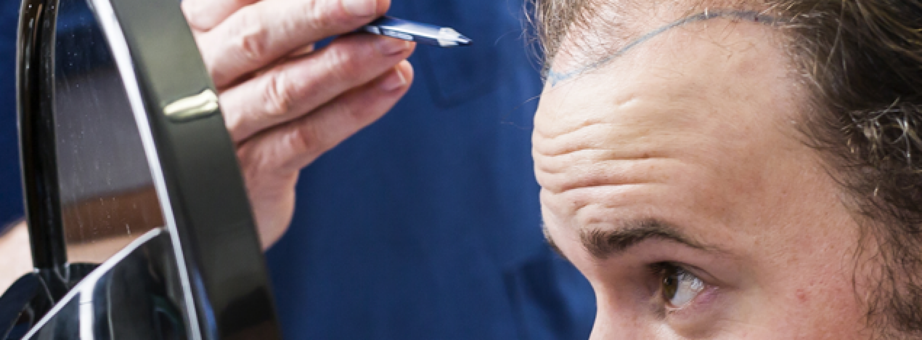 Alles wat je moet weten voor je een haartransplantatie ondergaat