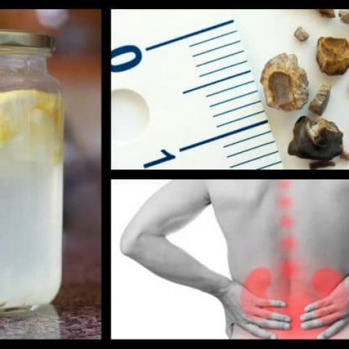 Top natuurlijke remedies voor nierstenen