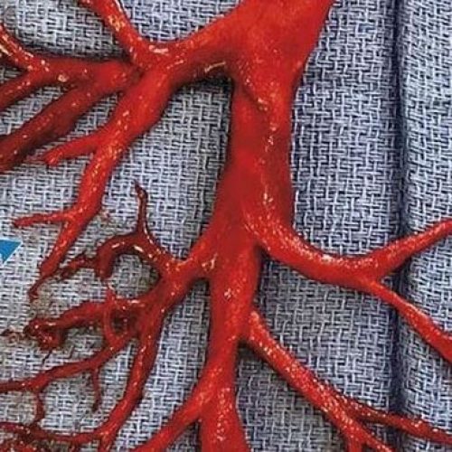 Waarschuwing voor Covid shots: zo ziet een bloedstolsel eruit wanneer VLOEIBAAR bloed verandert in een halfvaste gelatineuze massa in uw lichaam