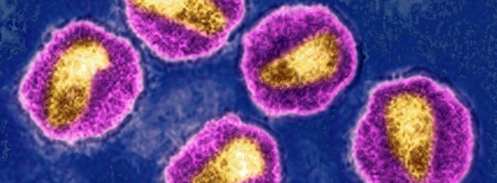 Zeer virulente hiv-variant ontdekt die in Europa circuleert