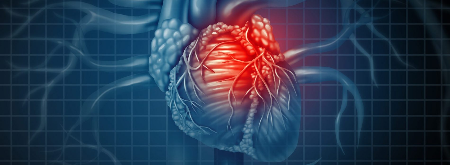 Aortastenose: de nieuwste zondebok voor hartaanvallen