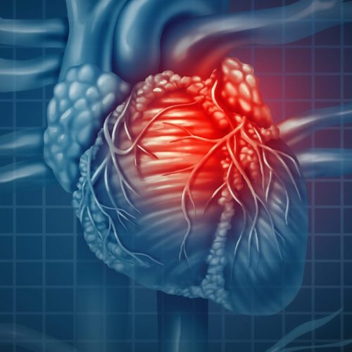 Aortastenose: de nieuwste zondebok voor hartaanvallen