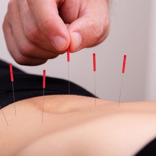 Nieuwe studie vindt dat acupunctuur mensen met diabetes kan helpen