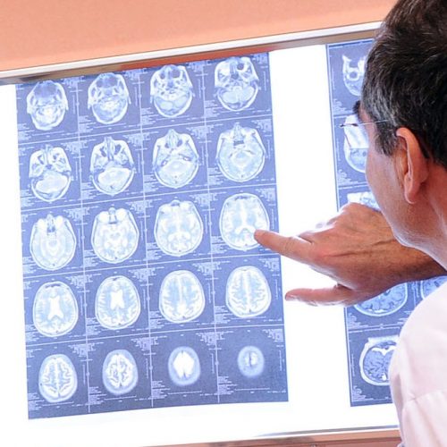 Fraude ONTHULD: Afbeeldingen die worden gebruikt in belangrijke Alzheimer-studies misleiden wetenschappers al meer dan een decennium