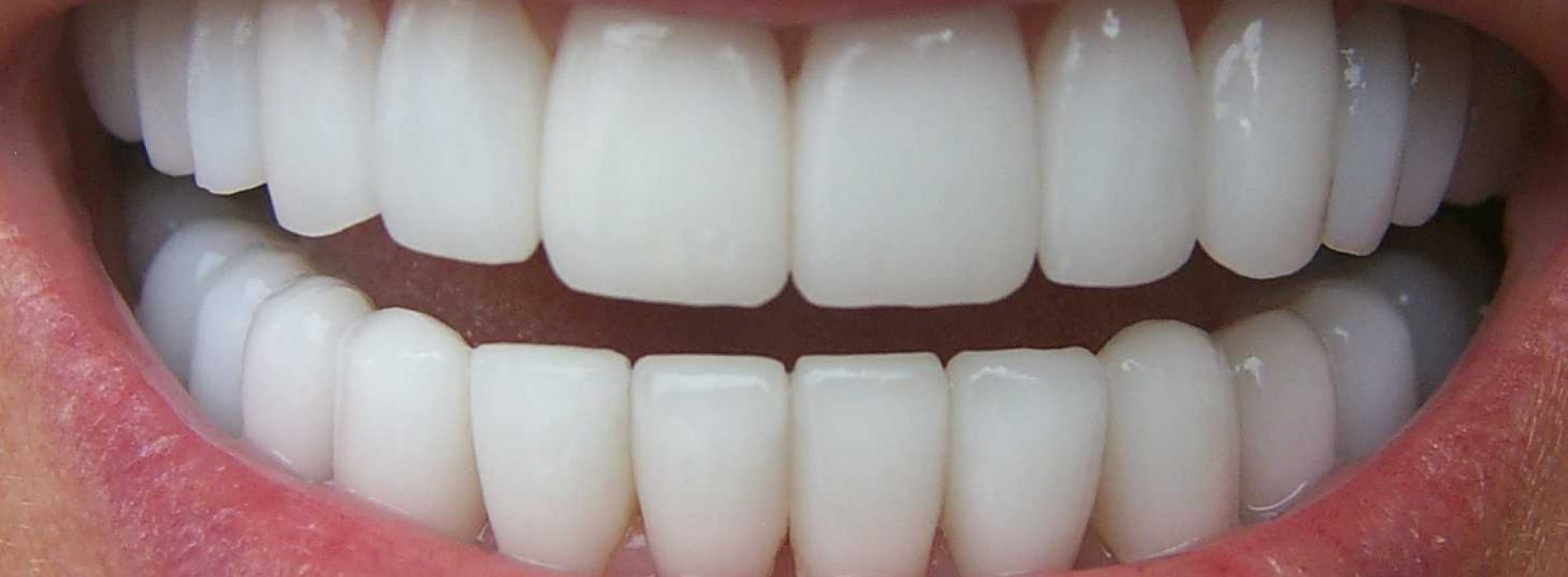 Ontdek 4 natuurlijke manieren om gingivitis en tandplak te bestrijden
