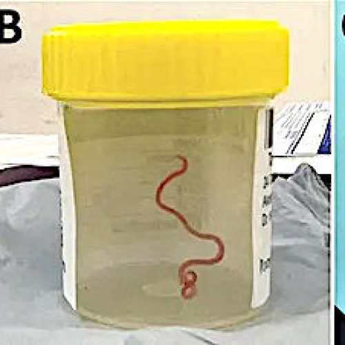 Australisch onderzoek waarschuwt voor parasitaire infecties na rondworm gevonden in de hersenen van vrouwen